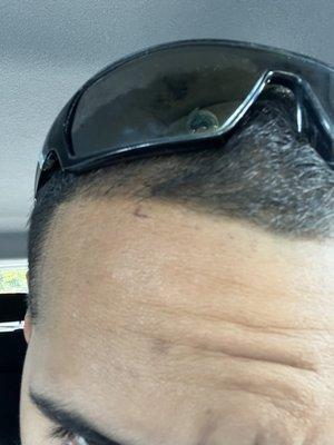 forehead cut