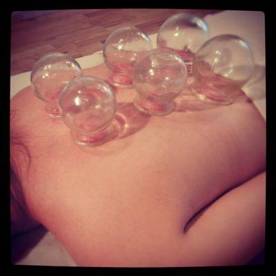 Cupping