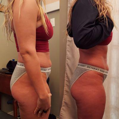 Non-Surgical Lipo - Fat Blast Treatment