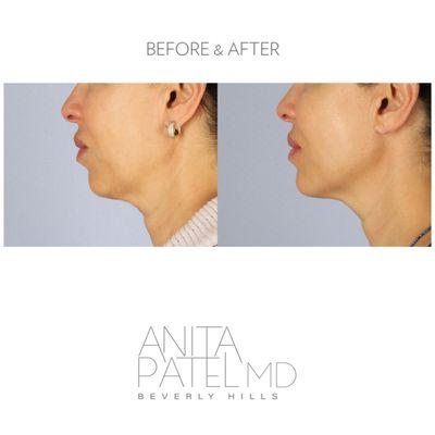 Jawline and Chin Filler