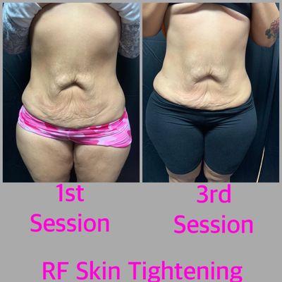 RF Skin Tightening assist with promoting production of collagen and elasticity! No Pain, No Surgery, No Down-Time!