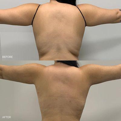 Liposuction of the arms along with liposuction of the back  by Dr. Gevorgyan!