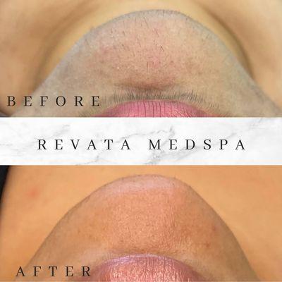 Revata Medspa Laser Facial with Microdermabrasion and skin Treatment