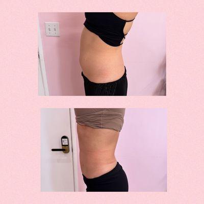 2 sessions of Lemon Bottle and 4 sessions of body contouring