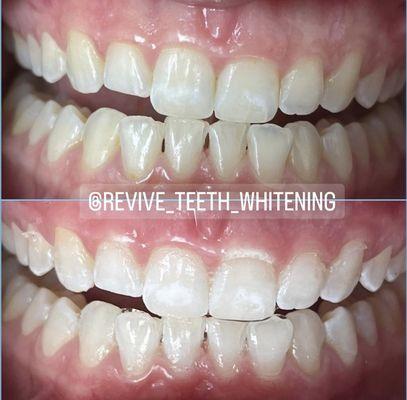 Before and After Teeth Whitening