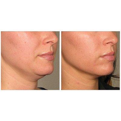 Ultherapy Before & After