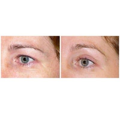 Botox eye brow lift and around crowsfeet