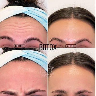 Botox before and after