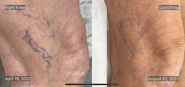 Before & After - Only 2 laser treatments for spider veins.