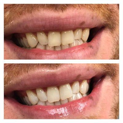 Zoom Whitening !