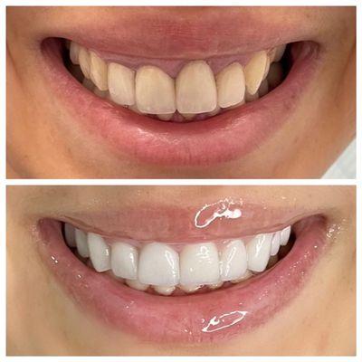 Veneers before and after