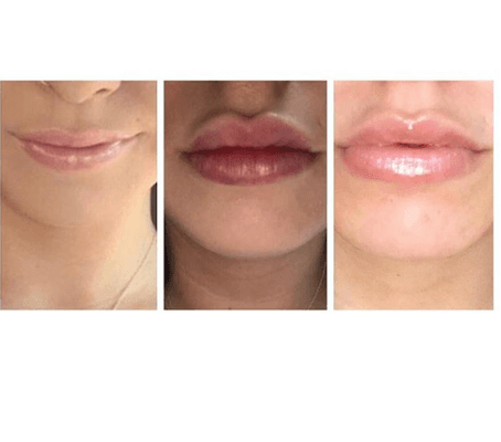 Botox, Lip injection, Juvederm, Jaw Cheek Contouring, Non surgical nose jobs, Laser facials, Kybella, Voluma, Microneedling, Chemical peel