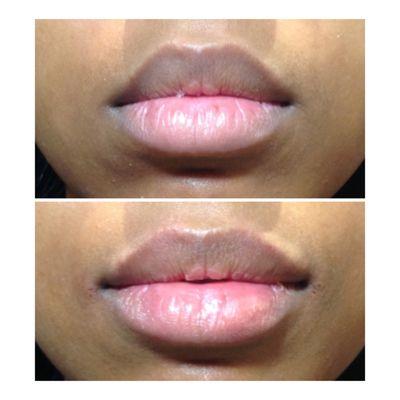 Lip filler before and after