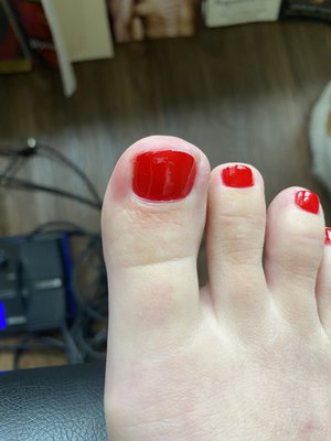 Swollen and red toe from digging into the side of my toe trying to remove an ingrown toenail (which he did not get out)