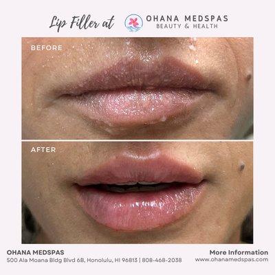 Achieve Your Dream Lips with Our Lip Filler and Lip Flip Special Discount! Book yours now or contact us at 808-468-2038.