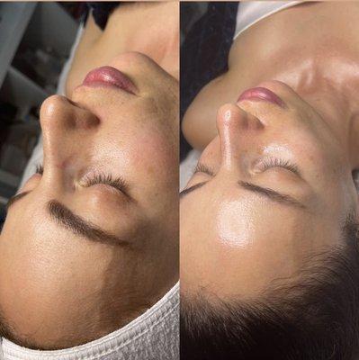 Microdermabrasion