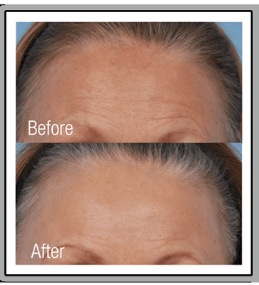 Pelleve Skin Tightening