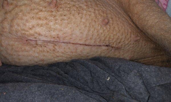 Very clean incision.