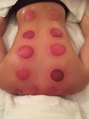 Cupping Therapy