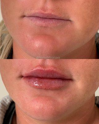 lip filler before and after