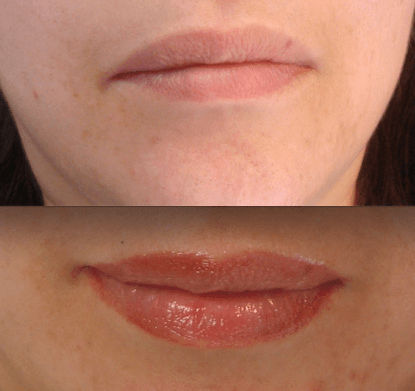 Before and After Lip Blushing