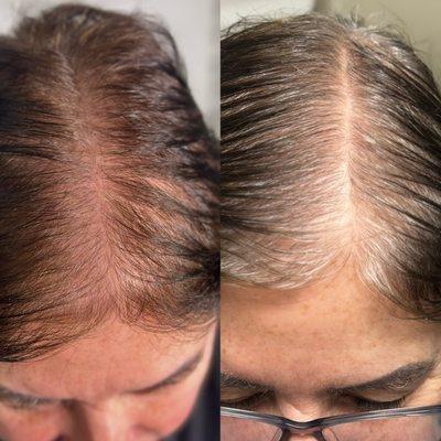 Hair Restoration with PRP + Potenza