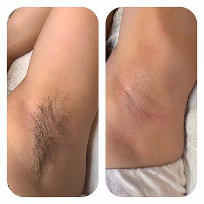 Underarm wax Before and After