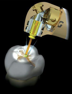 Laser Dentistry is minimally invasive dentistry