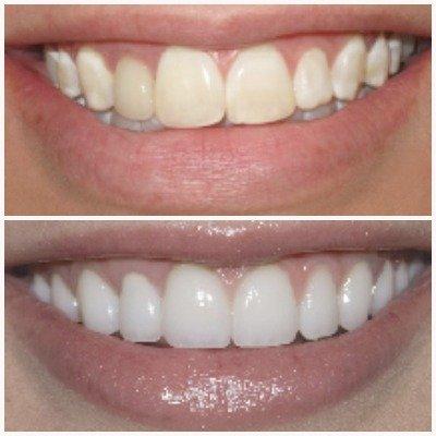 Love your smile! Before/after professional whitening!