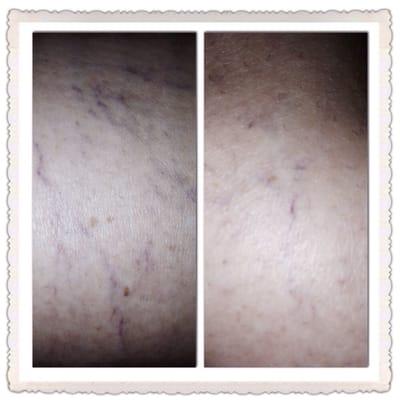 Before and After : spider veins- 2 treatments.