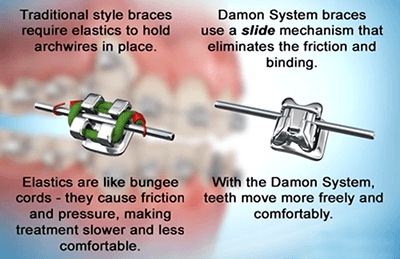 At Curtis Orthodontics we use Damon braces exclusively