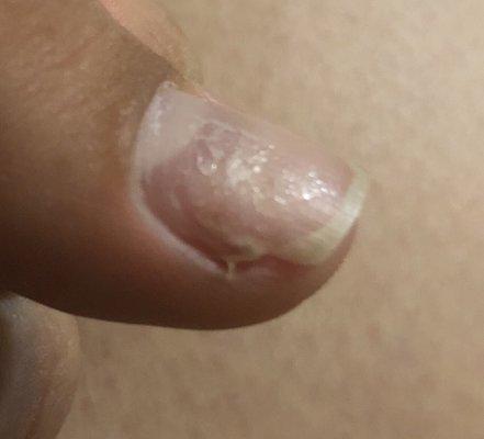 Broken nail