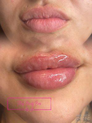 Client previously had needle lip fillers...she switched to needle-less fillers. We shaped and plumped up them
Book this service now