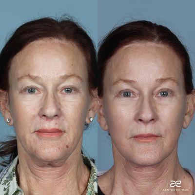 Secondary Facelift, neck lift, blepharoplasty, and fat grafting.