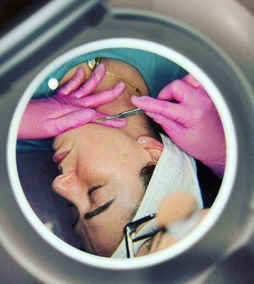 Dermaplaning