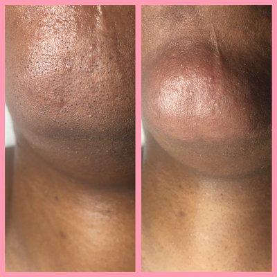 Before and after Chin extractions