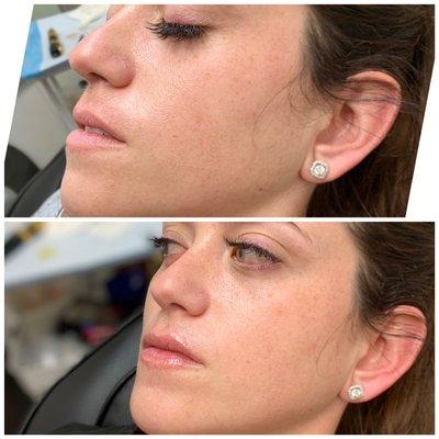 Hyaluronic Lip Fillers (Needle-Less)