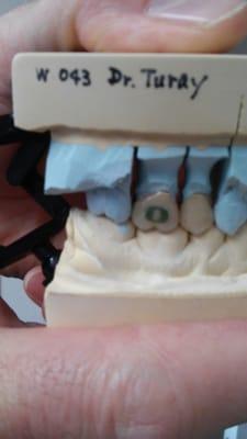 University of Oregon "O" on a rear molar. Go Ducks!