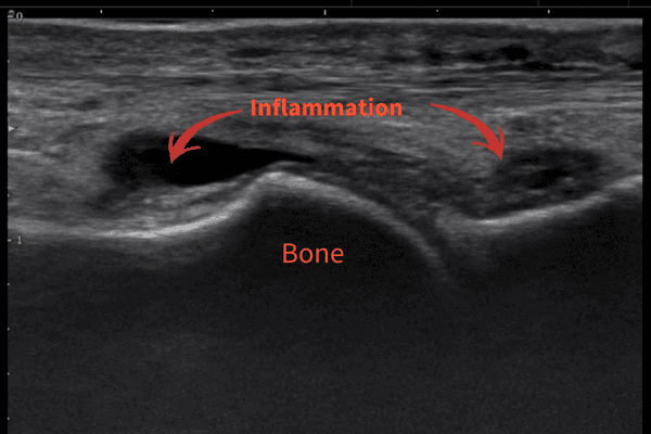 Ultrasound can identify the cause of pain immediately in most cases without the need for any further testing.