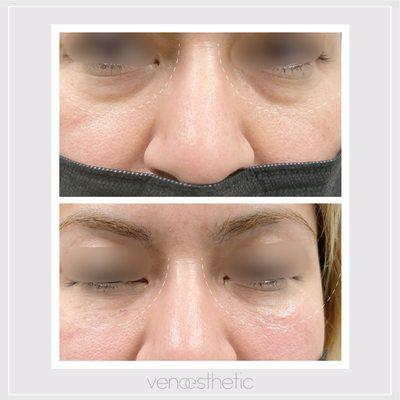 Under eye "bags" elimination using dermal filler.