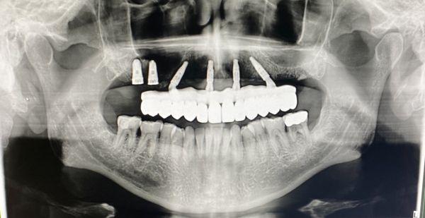 This is what we do in office. Same day Implant teeth