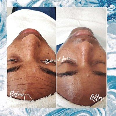 Microdermabrasion Facial