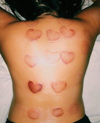 Heart shaped cupping