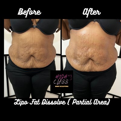 We offer Lipo fat dissolve!