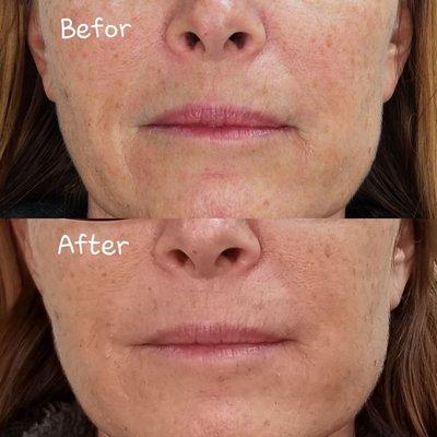 Plasma skin tightening