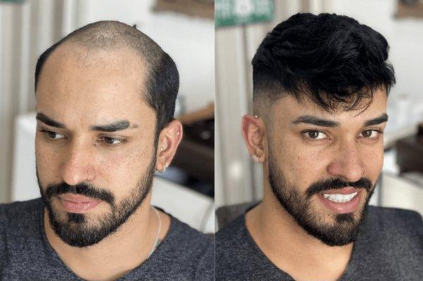 Lace Hair Club and Hair Restoration