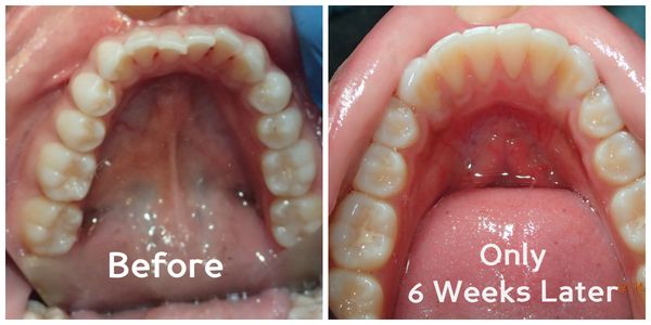 Get your teeth straightened without the hassle of metal and wires. Click here to see how they work https://www.youtube.com/wa...