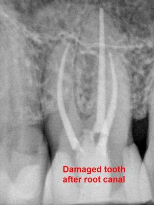 Damaged tooth after root canal