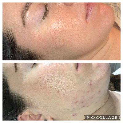 Before/after Acne client with sea rice skin. Monthly treatments and professional home care.