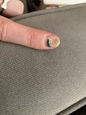 First fungal infection after my first and only time going to Helen's. I've been getting acrylics for 20 years in multiple states.